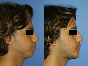 Antes y después de la cirugía maxilofacial