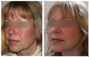 Los resultados del lifting