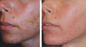 Tratamiento de peeling.