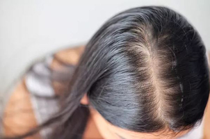 alopecia