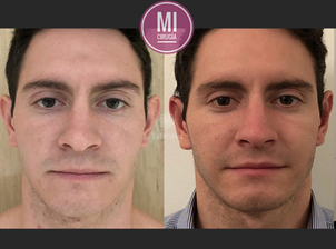 Riesgos de la cirugía