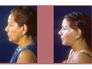 Antes y después de la cirugía