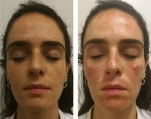 Resultados del tratamiento de eliminación de manchas.