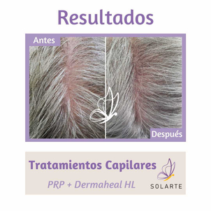 Profesional especializado en la aplicación Plasma Rico en Plaquetas.