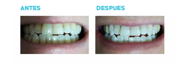 Antes y Despues del blanqueamiento dental