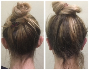 Resultados de la cirugía de orejas