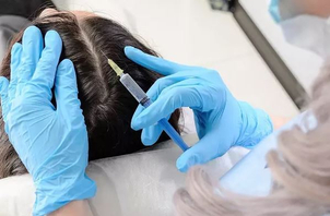 alopecia