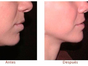 Problemas del mentón