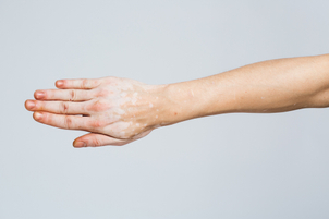 Diagnóstico de vitíligo.