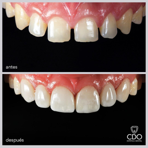 Resultado del blanqueamiento dental