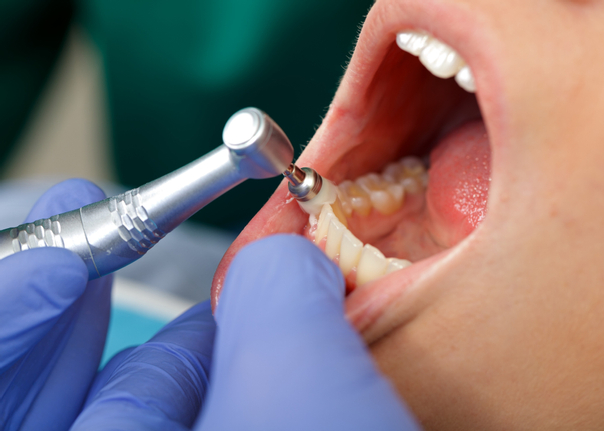 Se busca es la eliminación de la placa bacteriana, el sarro y manchas en los dientes