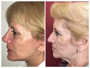 Pacientes aptos para tratamiento de rejuvenecimiento facial.