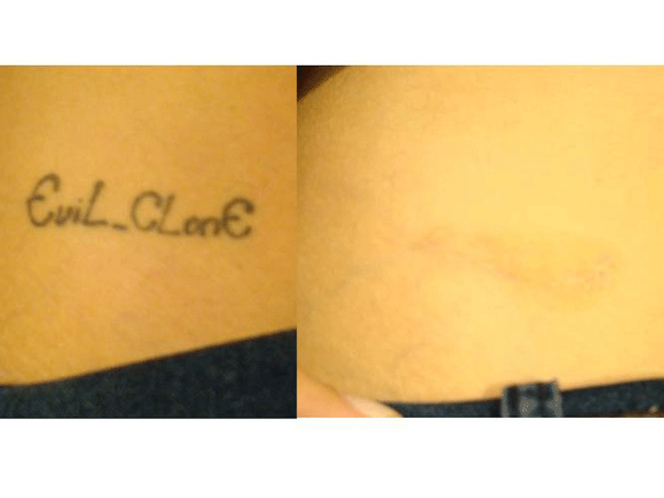 Antes y después de la eliminación de tatuaje con tratamiento láser. 