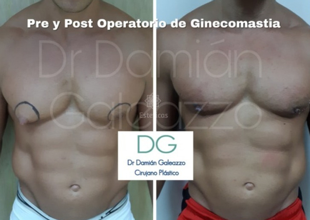 Antes y después de la ginecomastia