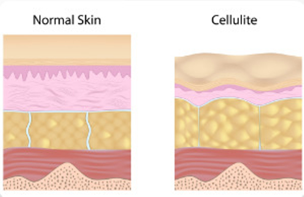 Las causas de la celulitis