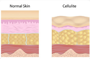 Las causas de la celulitis