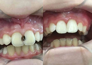 Recuperación tras el implante de prótesis dental.