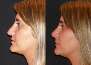 Paciente ideal para una rinomodelación.