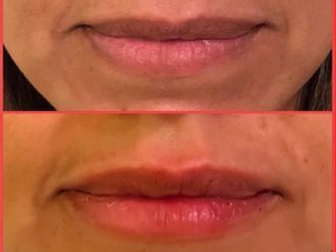 antes y después relleno facial