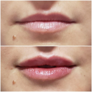 preparación relleno facual