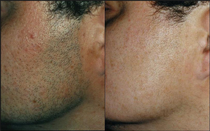 Paciente con rosácea.