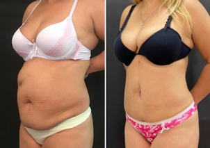 Antes y después de la dermolipectomía