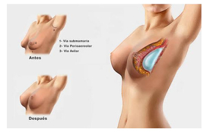 Colocación de implantes