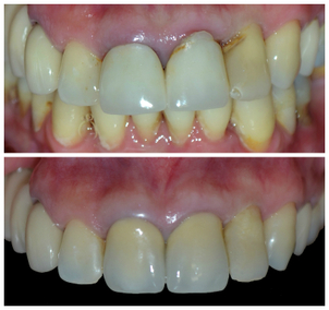 Paciente apto para uso de prótesis dental.