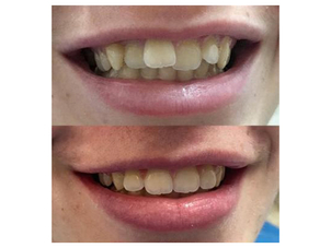 ¿Cómo sé si soy candidato a la ortodoncia?