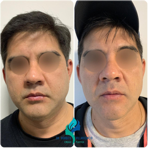 Candidatos a la bichectomía