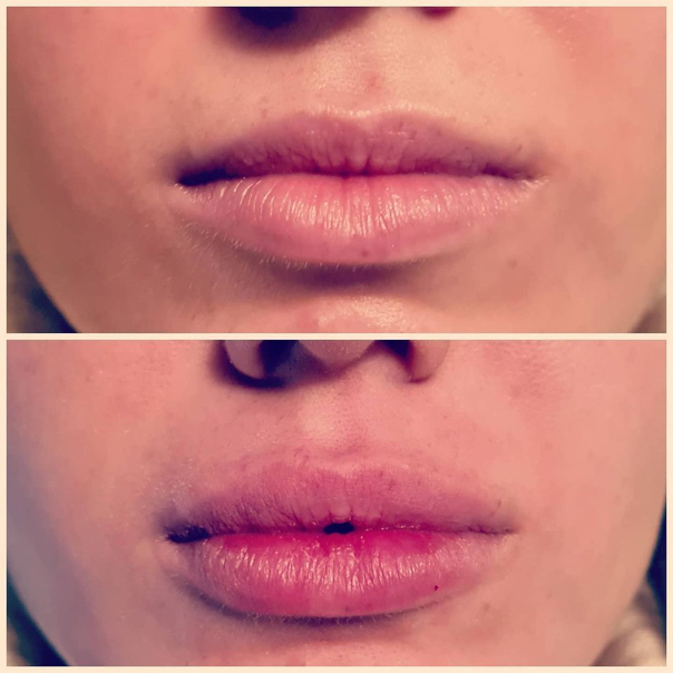 Antes y después relleno de labios