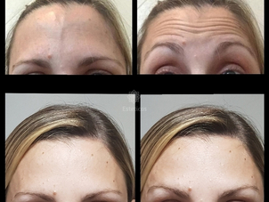 Cómo funciona el Botox
