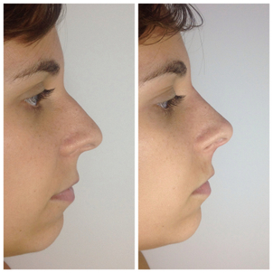 Resultadas de la rinomodelación.