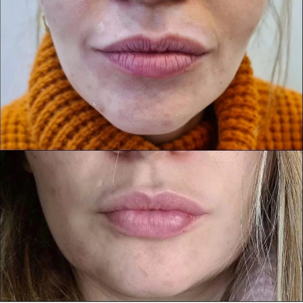 Tratamiento de rejuvenecimiento para labios