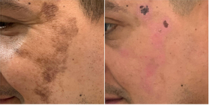 Concepto de manchas en la piel.