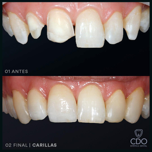 Carillas dentales, antes y después