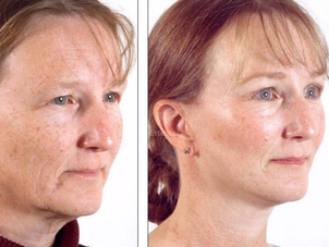 Antes y después de la cirugía maxilofacial