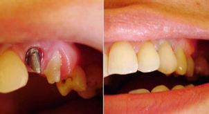 Instalación de la prótesis dental.