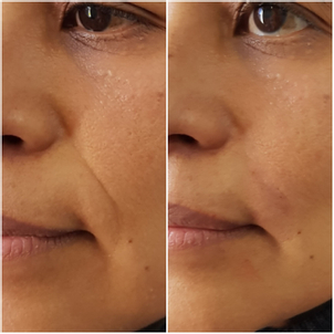 Tratamientos de rejuvenecimiento facial.