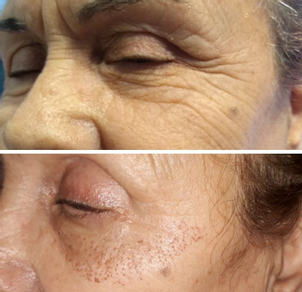 Qué es el rejuvenecimiento facial.