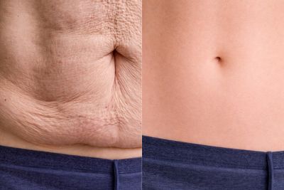 Antes y después de Abdominoplastía