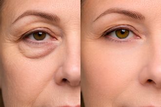 Antes y después de Blefaroplastia
