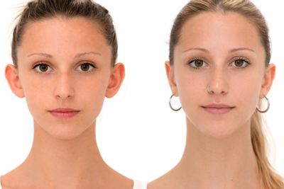 Antes y después de Otoplastia