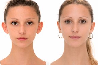 Antes y después de Otoplastia