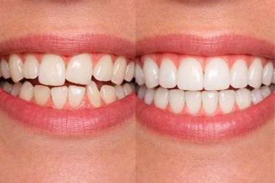 Antes y después de Ortodoncia