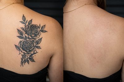 Antes y después de Borrar tatuajes