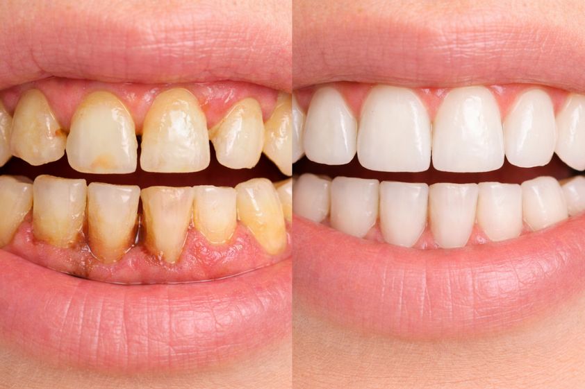 Periodoncia