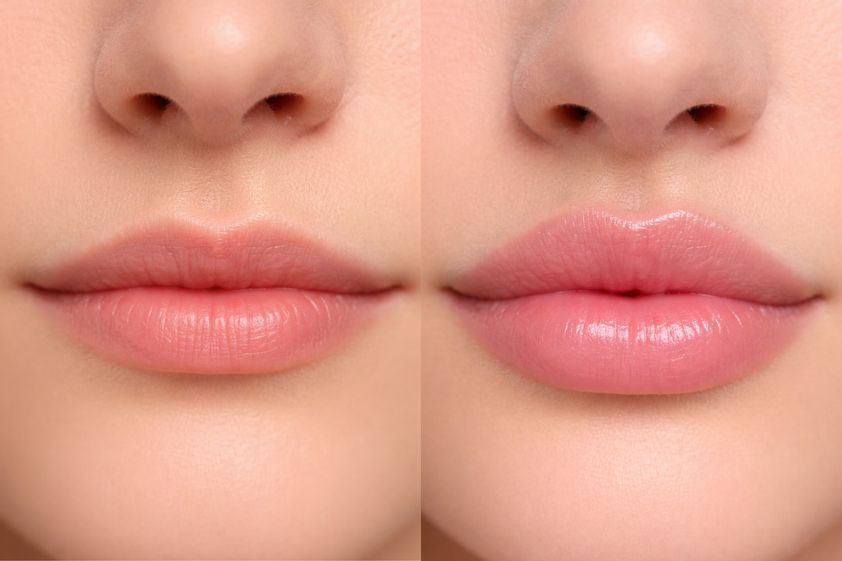 Relleno de labios