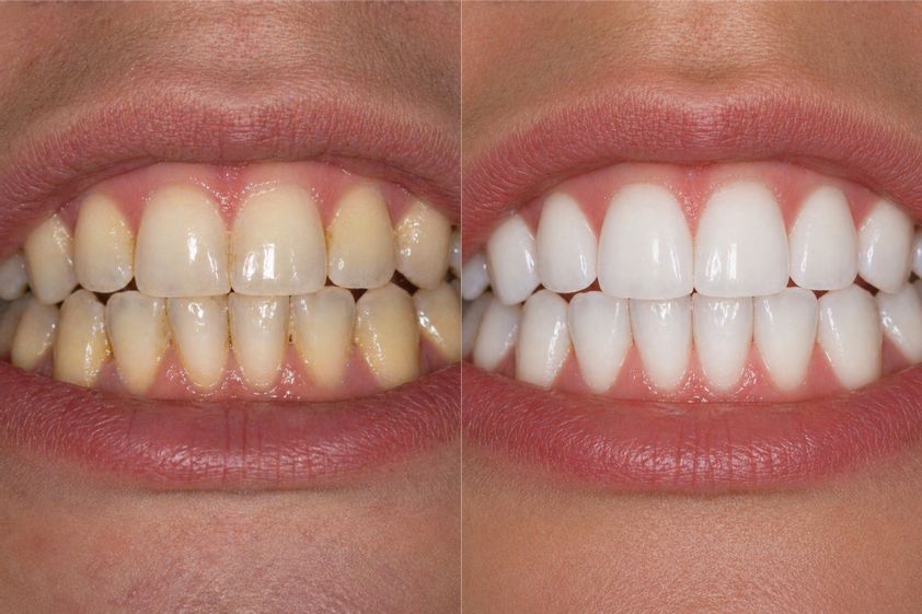 Limpieza dental
