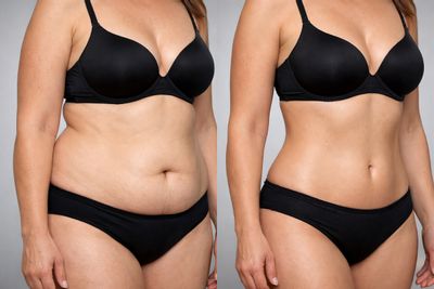 Antes y después de Lipoláser